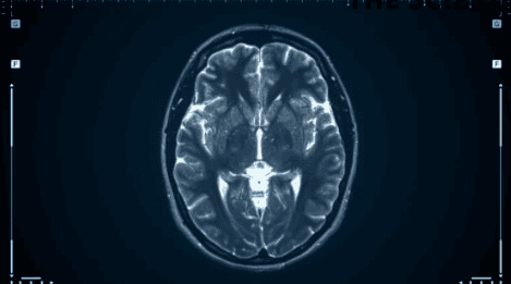 Addiction is a Brain Disease in scan form